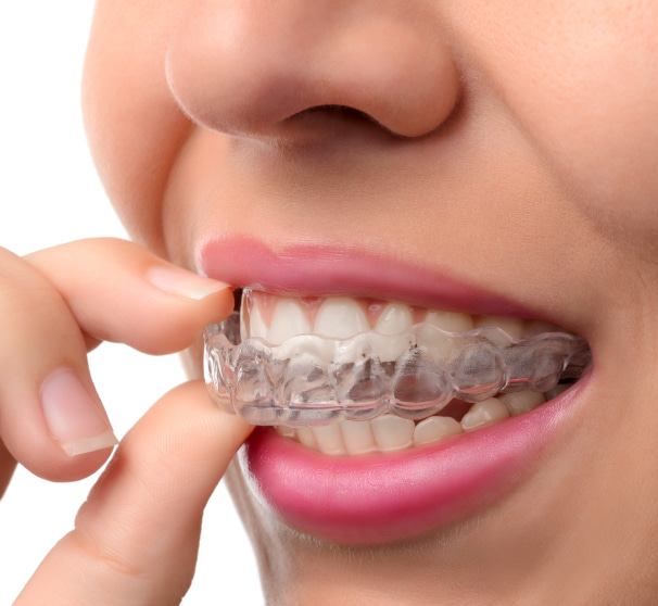 A woman with clear aligners in her mouth.