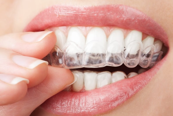 Invisalign Clear Aligners Near Me in Bothell, WA.