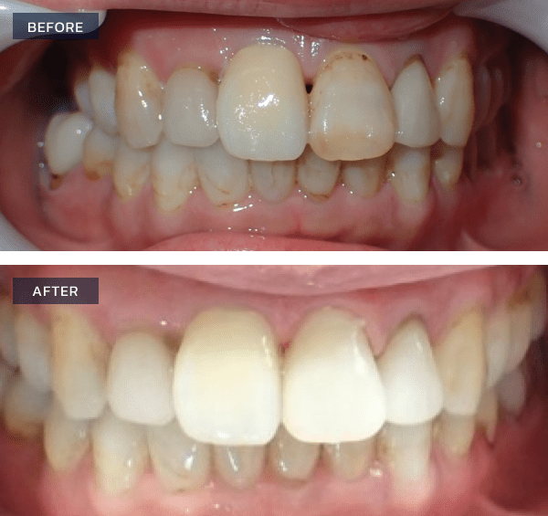 Pictures before and after same day single crown