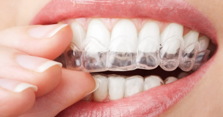 A female inserts her Invisalign tray.